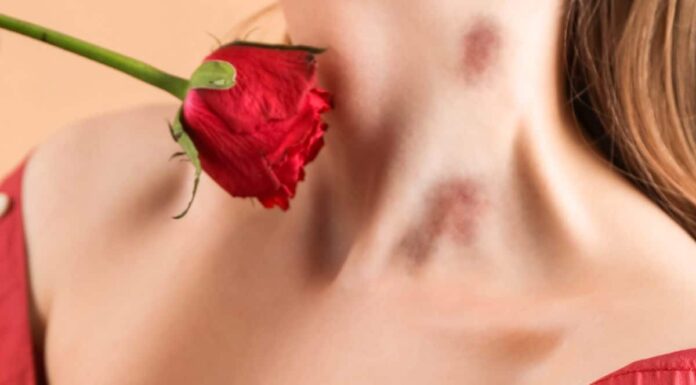 Как убрать засос: быстрые и проверенные способы экстренного устранения следа